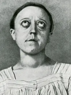 Bulging: Graves Disease