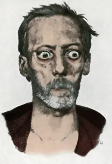Colorization: Graves Disease