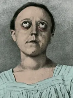 Colorization: Graves Disease
