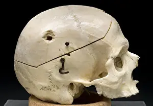 Forensic: Gunshot Trauma to Skull, 1950's