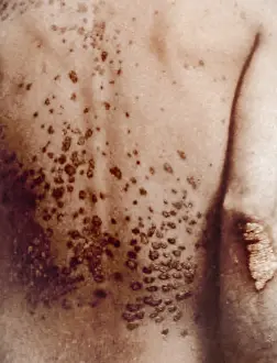 Abnormality: Guttate Psoriasis, Historical