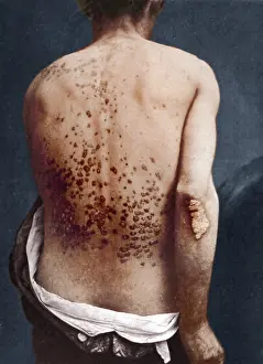 Pathological: Guttate Psoriasis, Historical
