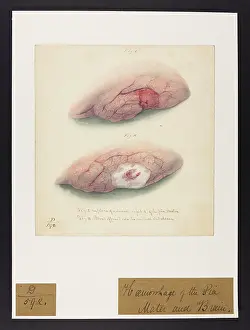 1827: Haemorrhage of Pia Mater and Brain