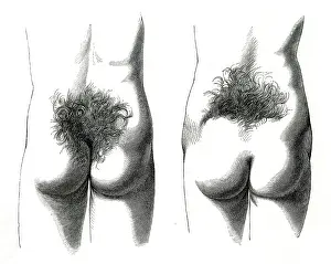 Growths: HAIR IN SMALL OF BACK