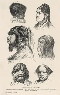 Hypertrichosis: HAIRY-FACED WOMEN