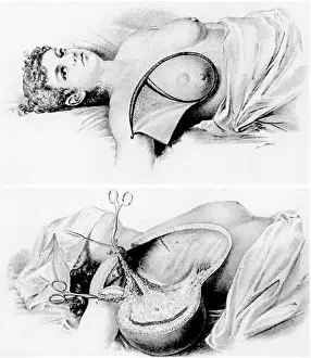 Sanitary: Halsted Radical Mastectomy, Incision and Final Cut