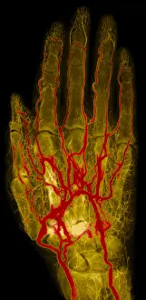 X Ray: Hand Arteriogram