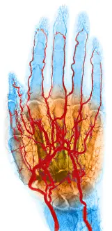 X Ray: Hand Arteriogram