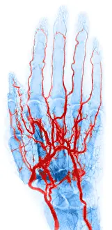 X Ray: Hand Arteriogram