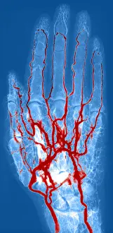 X Ray: Hand Arteriogram