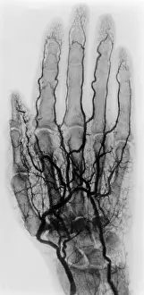 Vein: Hand Arteriogram