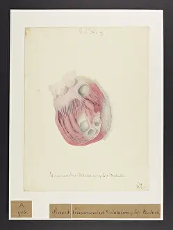 Unfinished: Heart: Circumscribed Dilatation of Left Ventricle