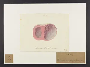 Verso: Heart: Dilatation of Right Ventricle