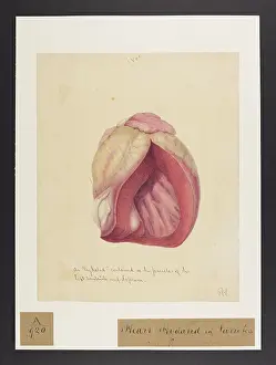 1837: Heart: Hydatid in Parietes