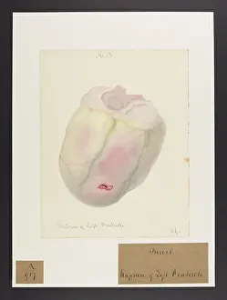 Verso: Heart: Rupture of Left Ventricle