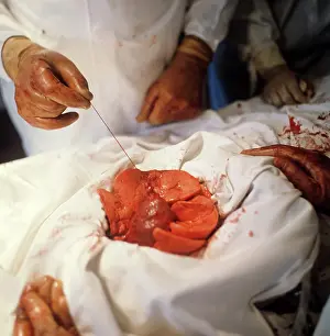 Lungs: Heart transplantation, 1973