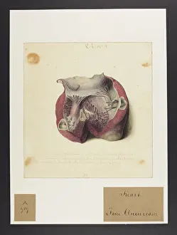1827: Heart: True Aneurysm