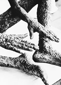 Wiped: The heavily pockmarked hands, legs, and ?