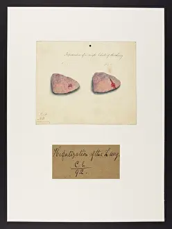 Lung: Hepatization of a Single Lobule of the Lung