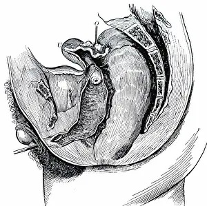 1815: Hermaphroditism: Mesial section showing the generative