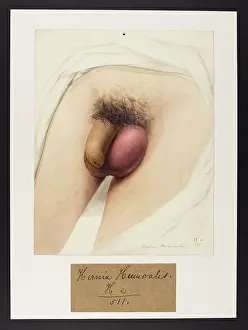 Hospice: Hernia Humoralis