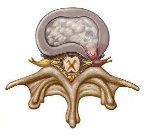 Nerve: Herniated Disk, Illustration