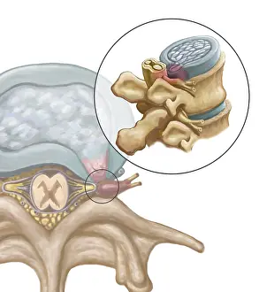 Nerve: Herniated Disk, Illustration
