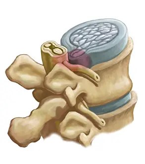 Nerve: Herniated Disk, Illustration