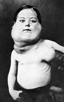 Progressive: Hodgkin's Disease, 1892