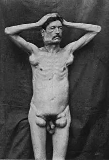 Progressive: Hodgkin's Disease, 1892