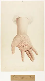Syphilis: Horny Syphilis