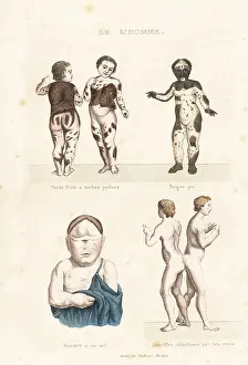 Tardieu: Human disorders