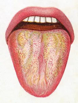 Fever: Human tongue during a fever