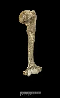Humerus: Humerus of Achondroplastic Dwarf