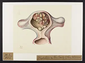 Hydatids: Hydatids: Cavity of Uterus