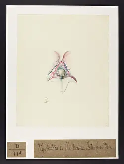Hydatids: Hydatids: Celluar Tissue of the Velum Interpositum