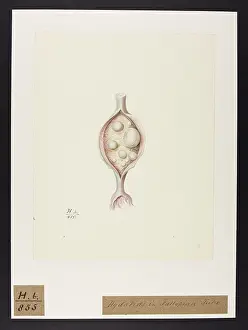 Hydatids: Hydatids: Fallopian Tube