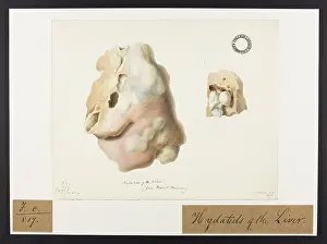 Liver: Hydatids of the Liver