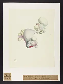 Hydatids: Hydatids: Peritoneal Surface of Uterus & Ovaries