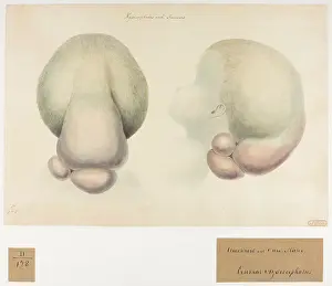 1827: Hydrocephalus