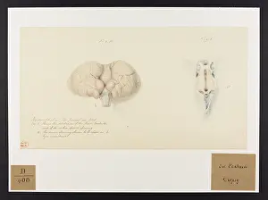 Femmes: Hydrocephalus: The Patient an Idiot