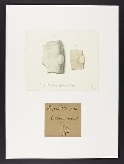 1831: Hypertrophy of a Gland of Peyer