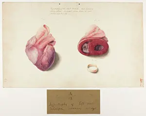 Hopital: Hypertrophy of Left Ventricle