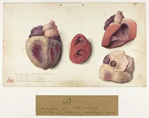 Contraction: Hypertrophy of Right Ventricle