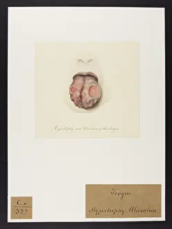 Ucl Library Services Digital Collections: Hypertrophy and Ulceration of the Tongue