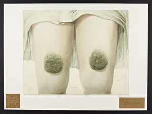 Hopital: Icthyosis
