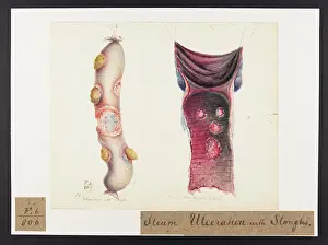 Ucl Library Services Digital Collections: Ileum: Ulceration and Sloughs