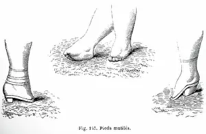 Consequences: Illustration showing consequences of foot binding