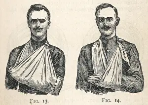 Slings: Illustrations of large and small arm slings