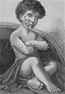 Sores: IMPETIGO SUFFERER